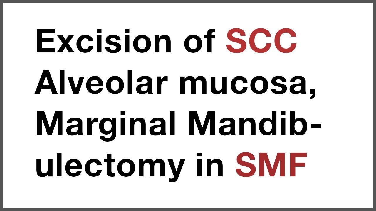 Excision of SCC Alveolar mucosa, Marginal Mandibulectomy in Submucous Fibrosis SMF