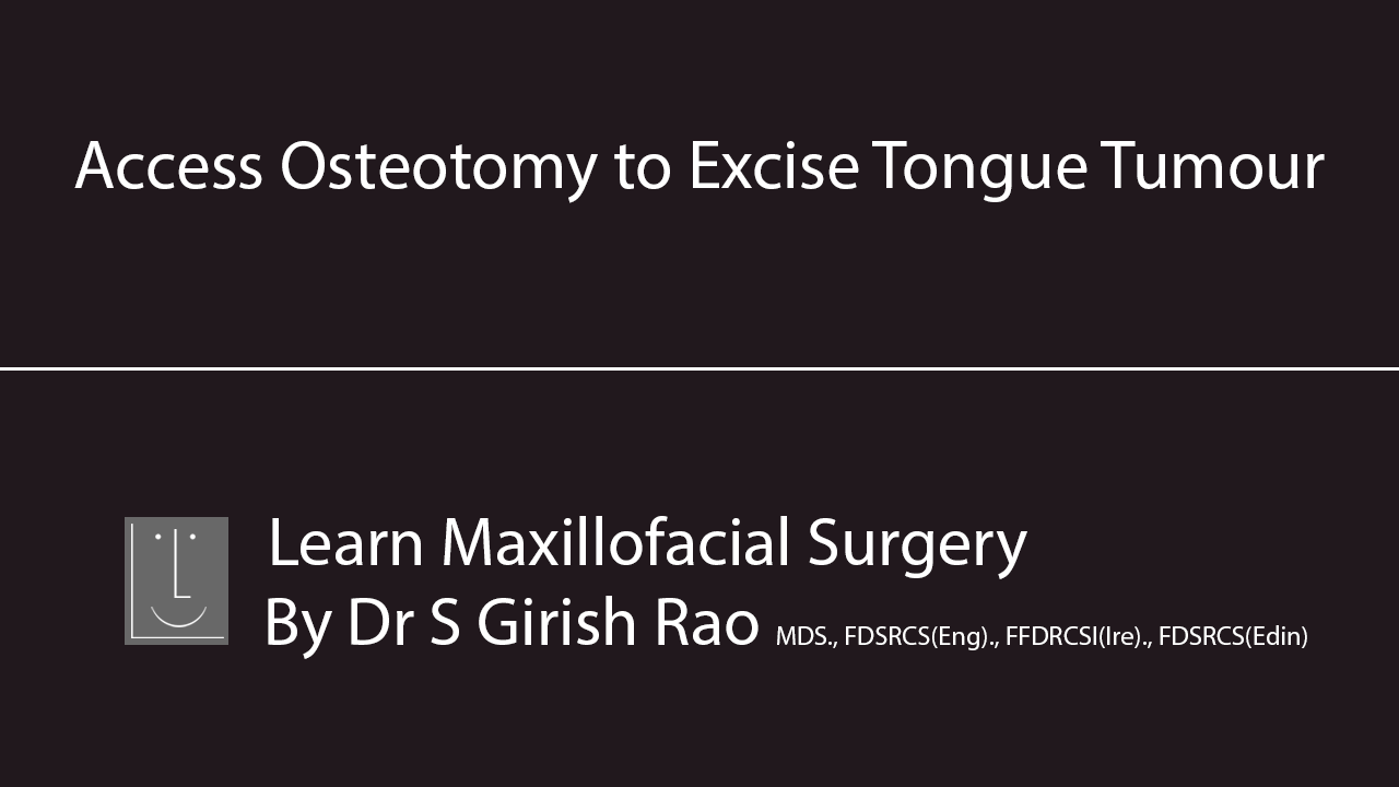 Bilateral Maxillectomy Mucormycosis